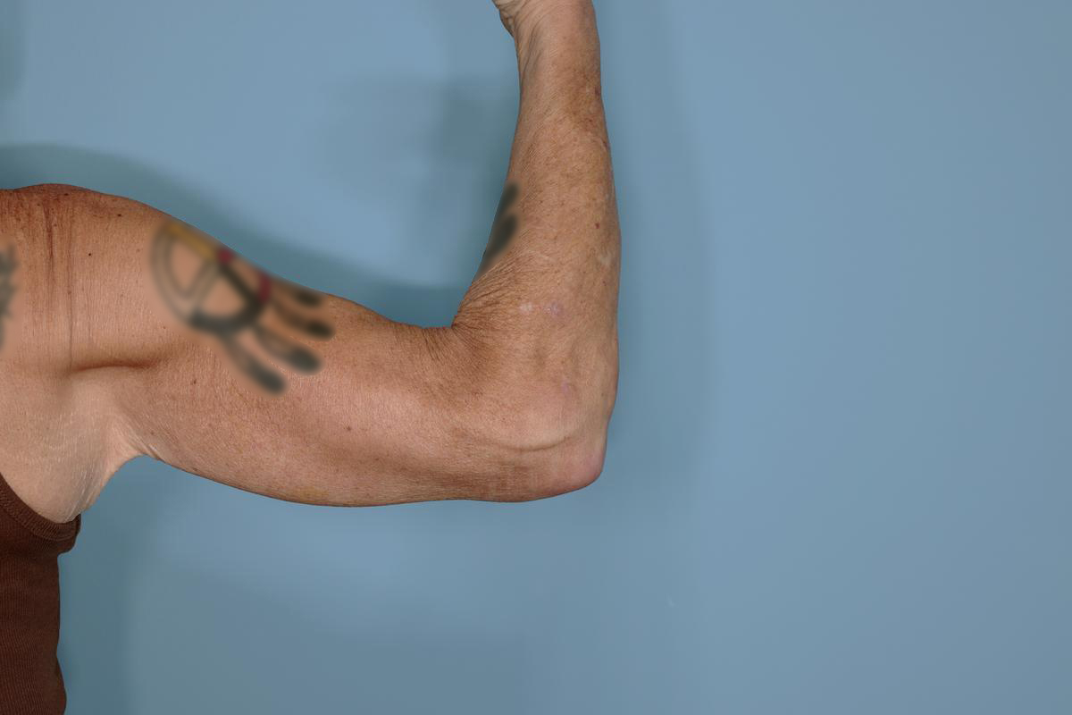 Brachioplasty Before & After Patient #604