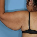Brachioplasty Before & After Patient #591