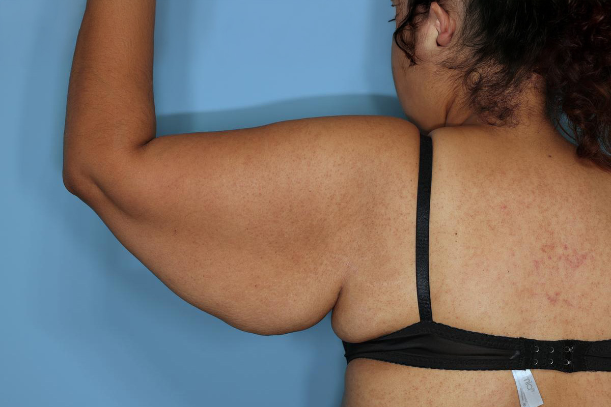 Brachioplasty Before & After Patient #591