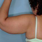 Brachioplasty Before & After Patient #591