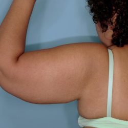 Brachioplasty Before & After Patient #591