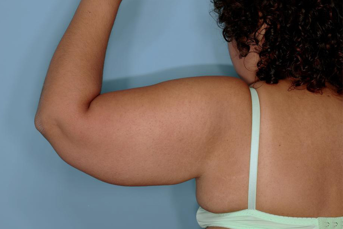 Brachioplasty Before & After Patient #591
