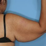 Brachioplasty Before & After Patient #591