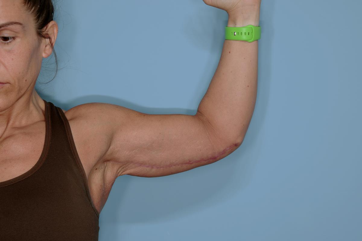 Brachioplasty Before & After Patient #592
