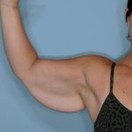 Brachioplasty Before & After Patient #592