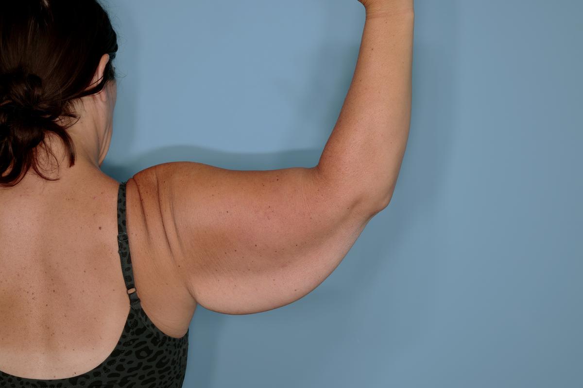 Brachioplasty Before & After Patient #592