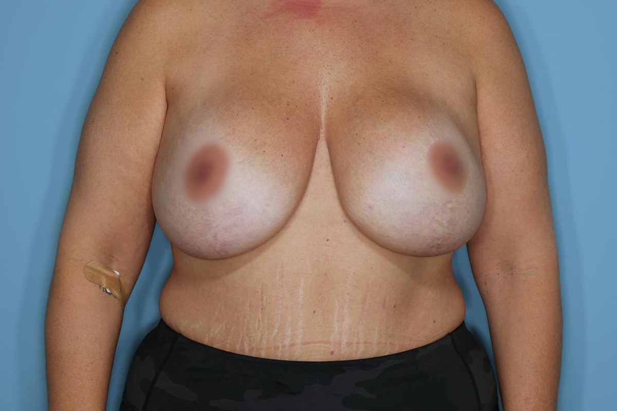 Implant Removal Lift Before & After Patient #717
