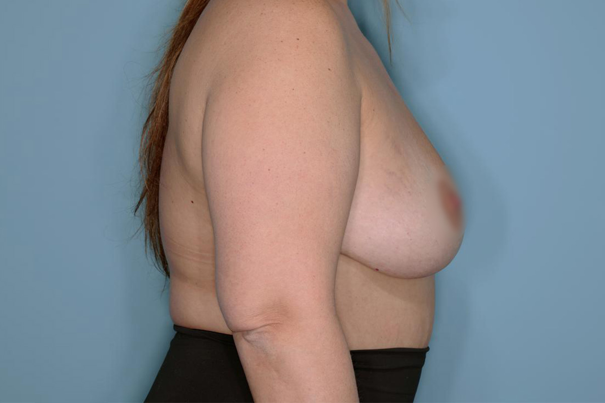 Implant Removal Lift Before & After Patient #717