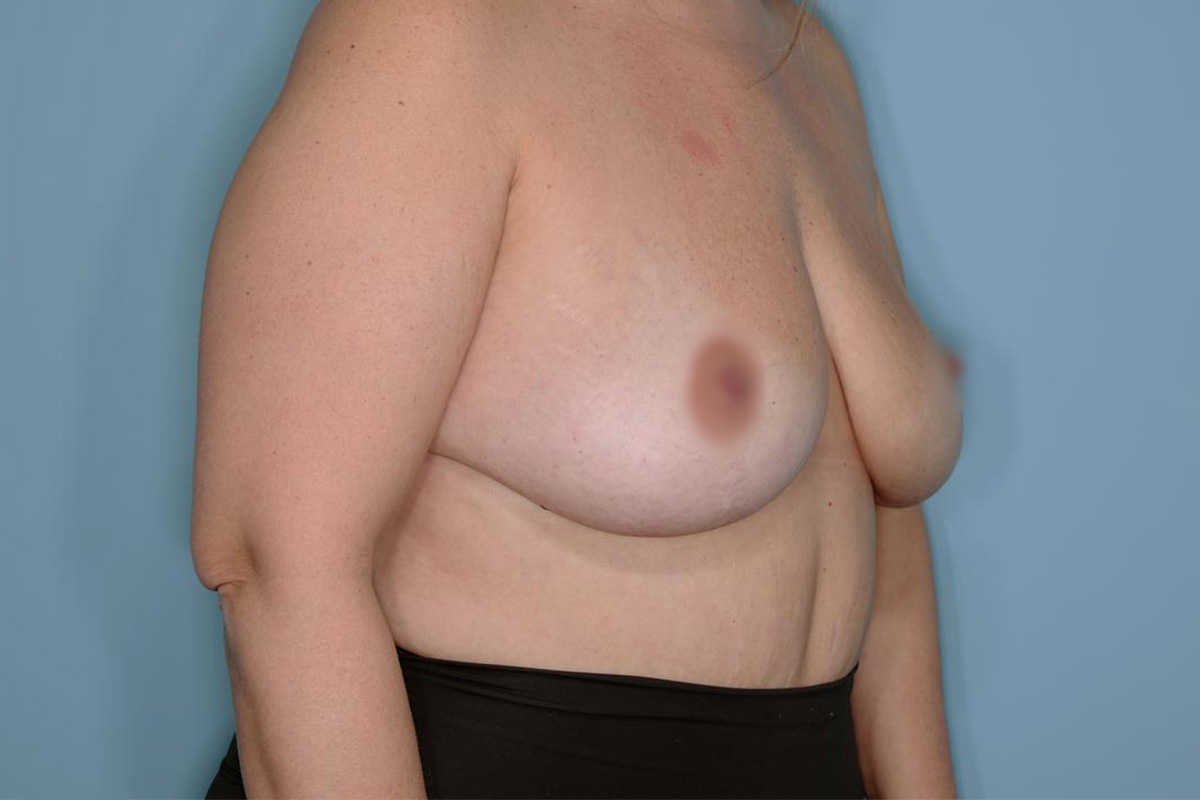 Implant Removal Lift Before & After Patient #717