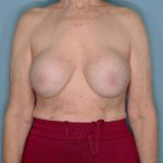Implant Removal Lift Before & After Patient #653