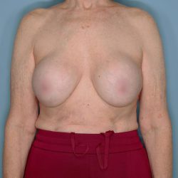 Implant Removal Lift Before & After Patient #653