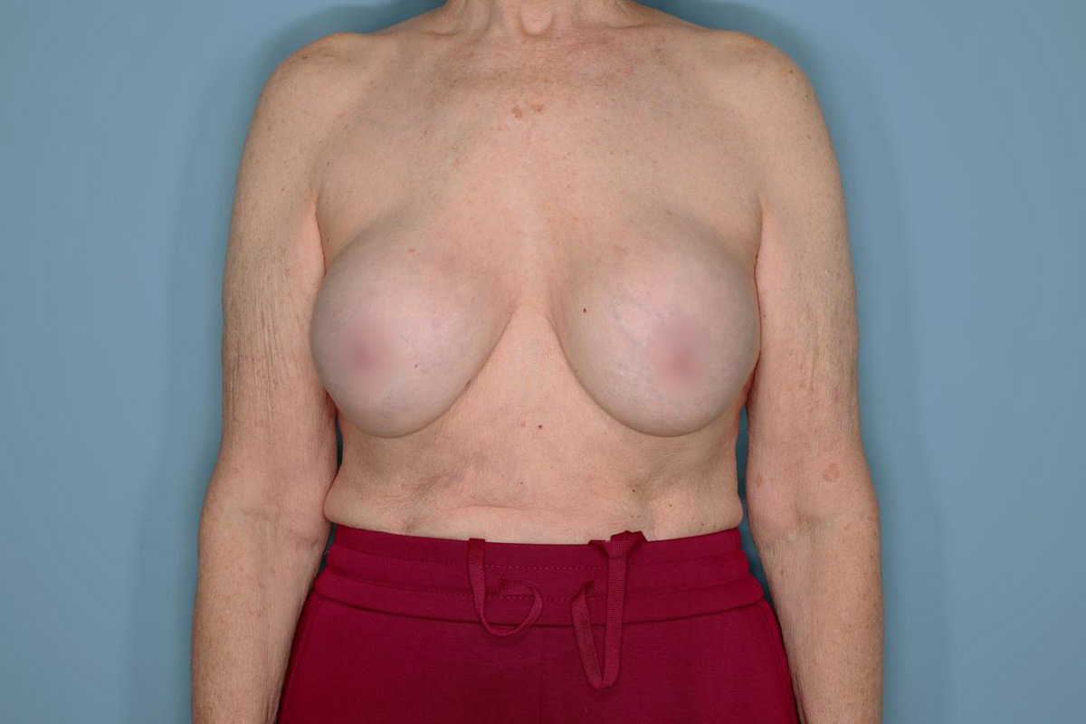 Implant Removal Lift Before & After Patient #653