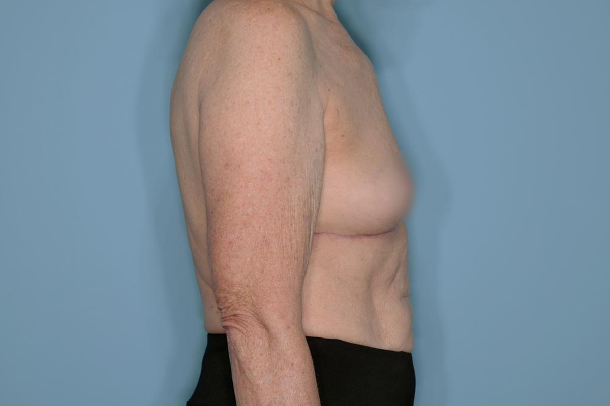 Implant Removal Lift Before & After Patient #653