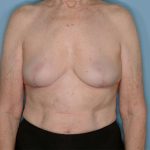 Implant Removal Lift Before & After Patient #653