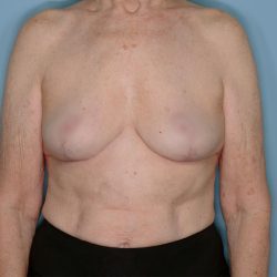 Implant Removal Lift Before & After Patient #653