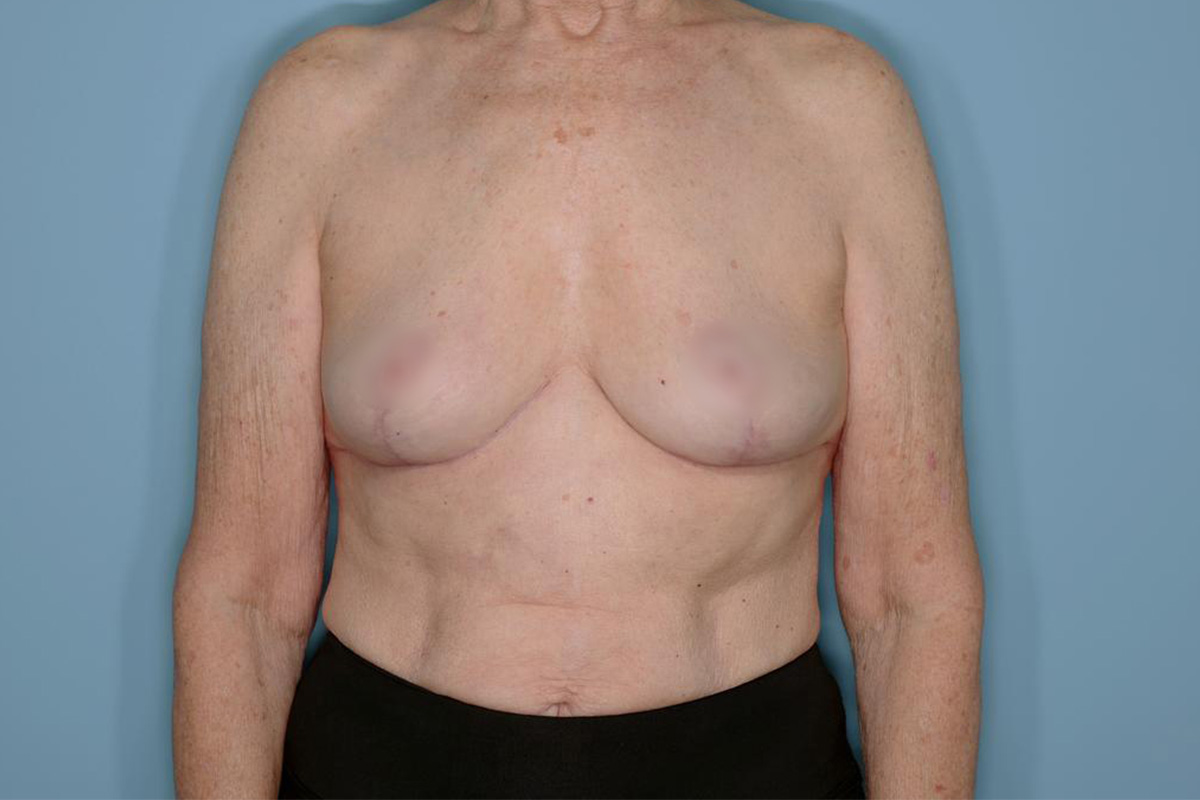 Implant Removal Lift Before & After Patient #653