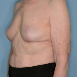 Implant Removal Lift Before & After Patient #653
