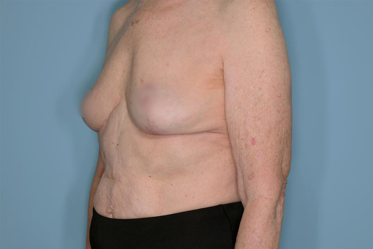 Implant Removal Lift Before & After Patient #653