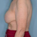 Implant Removal Lift Before & After Patient #653