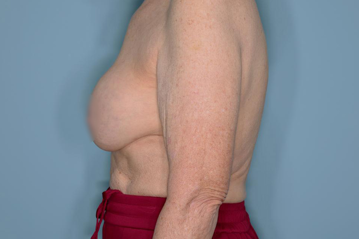 Implant Removal Lift Before & After Patient #653