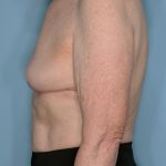 Implant Removal Lift Before & After Patient #653