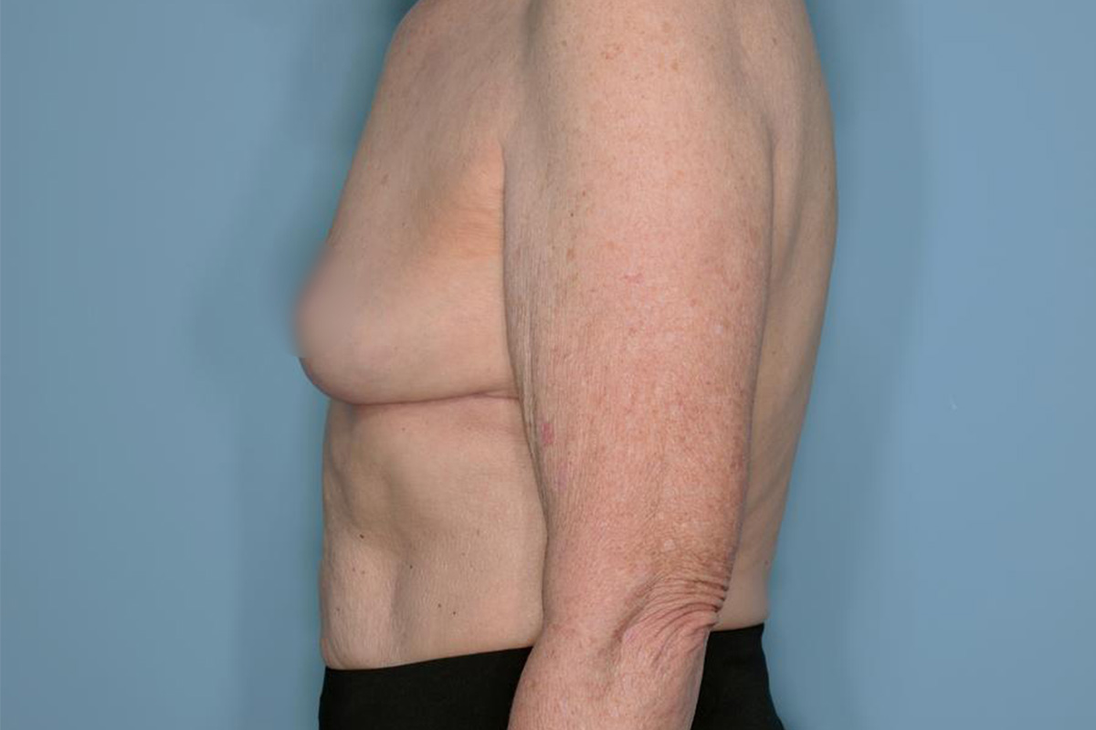 Implant Removal Lift Before & After Patient #653