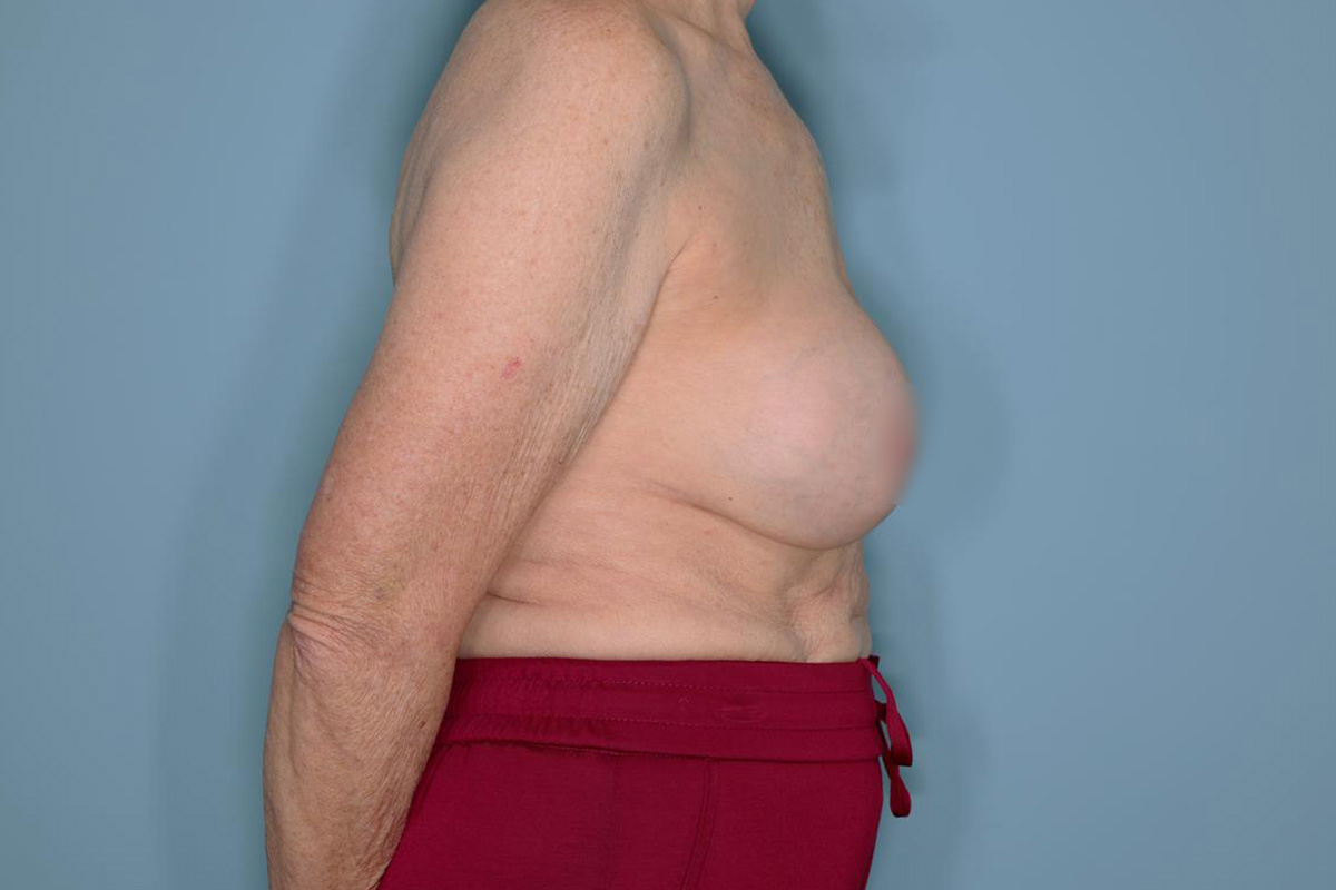 Implant Removal Lift Before & After Patient #653