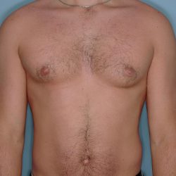Gynecomastia Before & After Patient #721