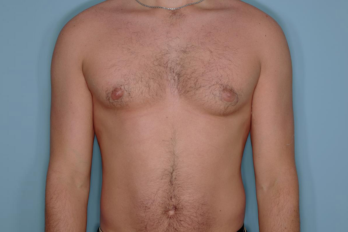 Gynecomastia Before & After Patient #721