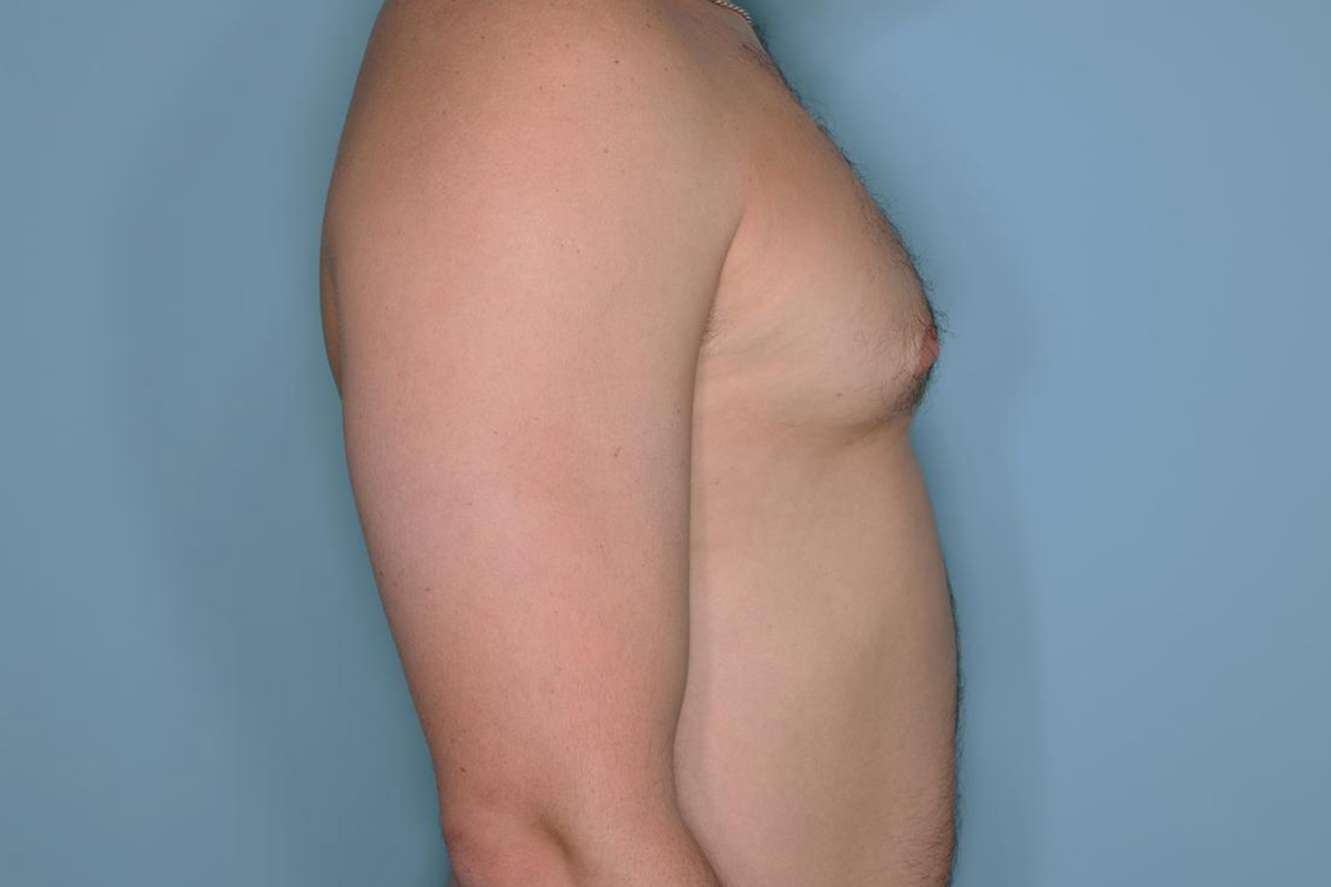 Gynecomastia Before & After Patient #721