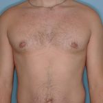 Gynecomastia Before & After Patient #721
