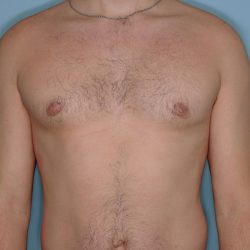 Gynecomastia Before & After Patient #721