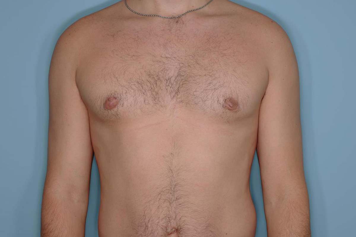 Gynecomastia Before & After Patient #721