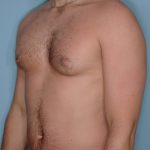 Gynecomastia Before & After Patient #721
