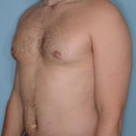 Gynecomastia Before & After Patient #721