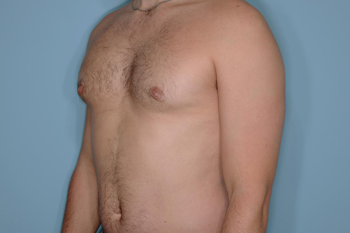 Gynecomastia Before & After Patient #721