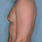Gynecomastia Before & After Patient #721