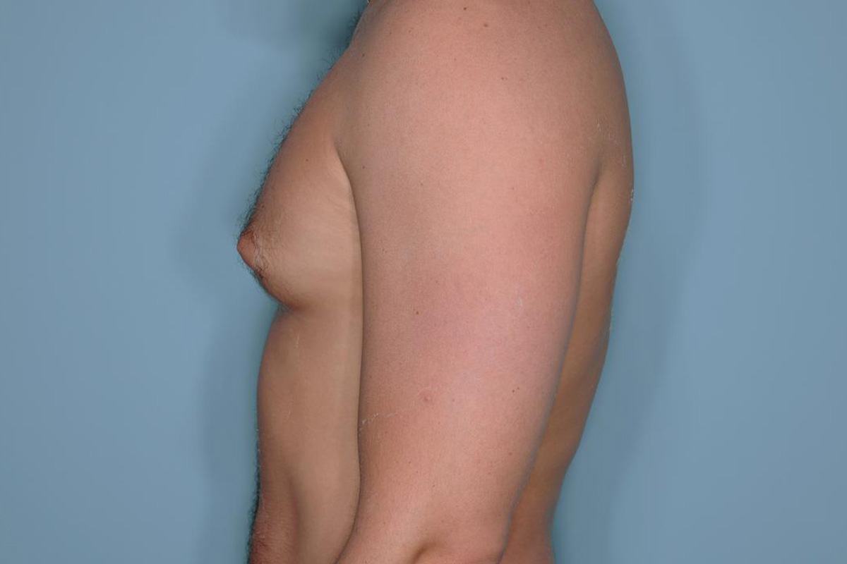 Gynecomastia Before & After Patient #721