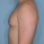 Gynecomastia Before & After Patient #721