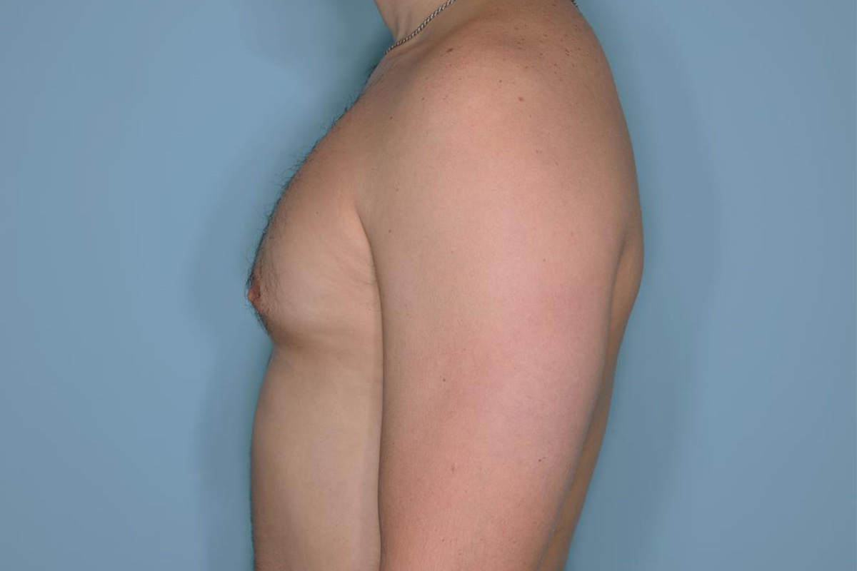 Gynecomastia Before & After Patient #721
