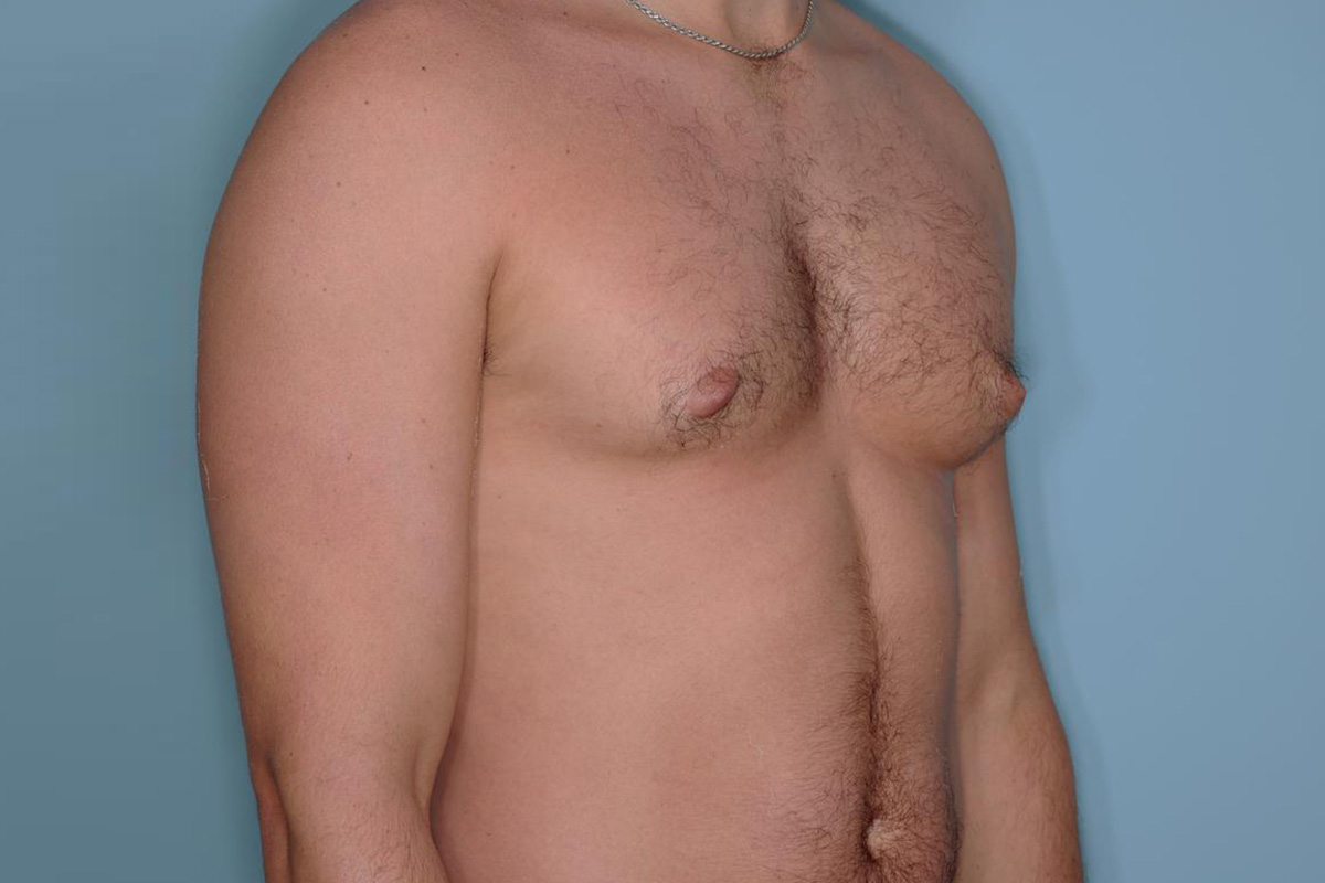 Gynecomastia Before & After Patient #721