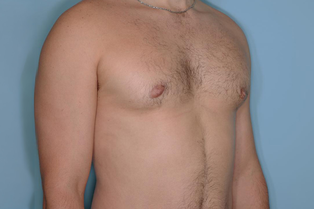 Gynecomastia Before & After Patient #721