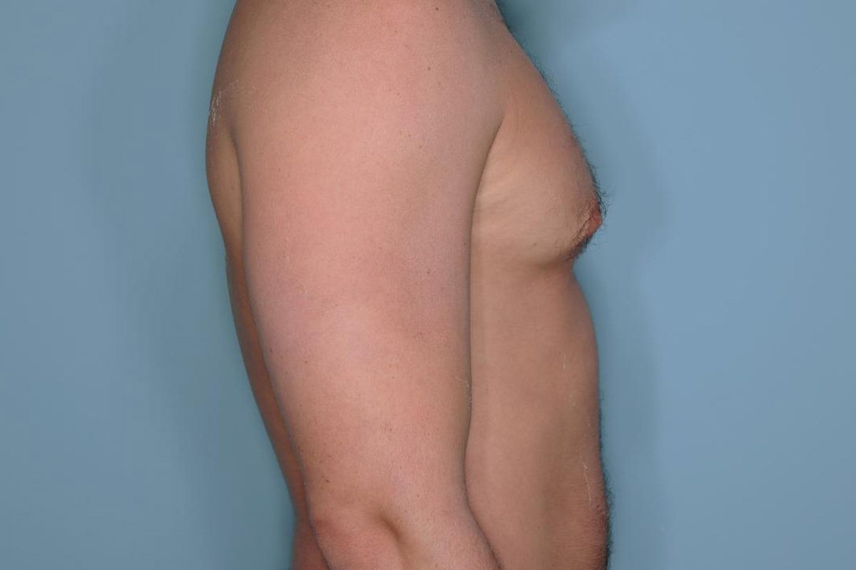 Gynecomastia Before & After Patient #721