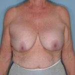 Implant Exchange Lift Before & After Patient #651
