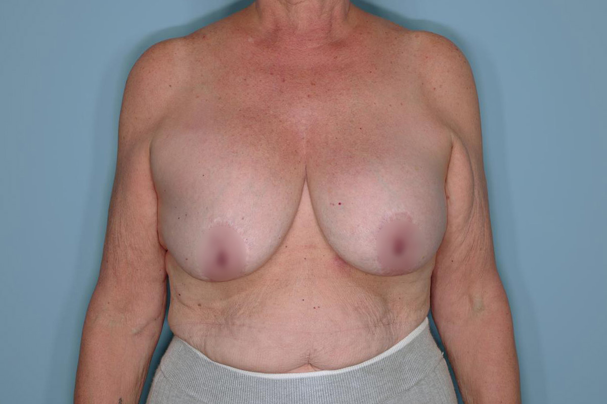 Implant Exchange Lift Before & After Patient #651