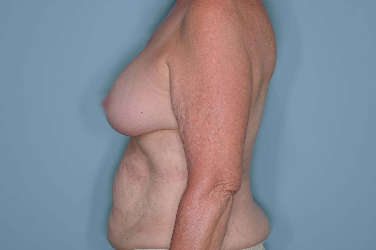 Implant Exchange Lift Before & After Patient #651
