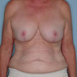 Implant Exchange Lift Before & After Patient #651