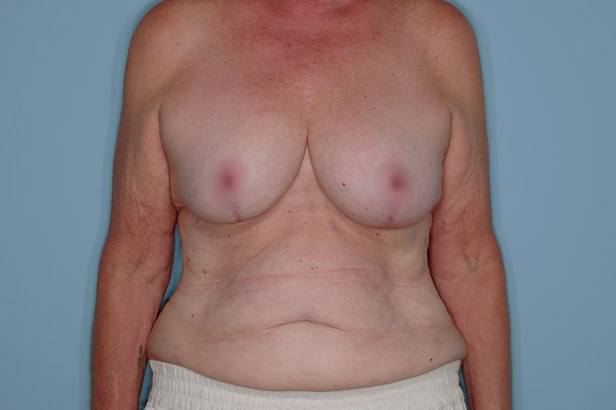 Implant Exchange Lift Before & After Patient #651