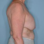 Implant Exchange Lift Before & After Patient #651