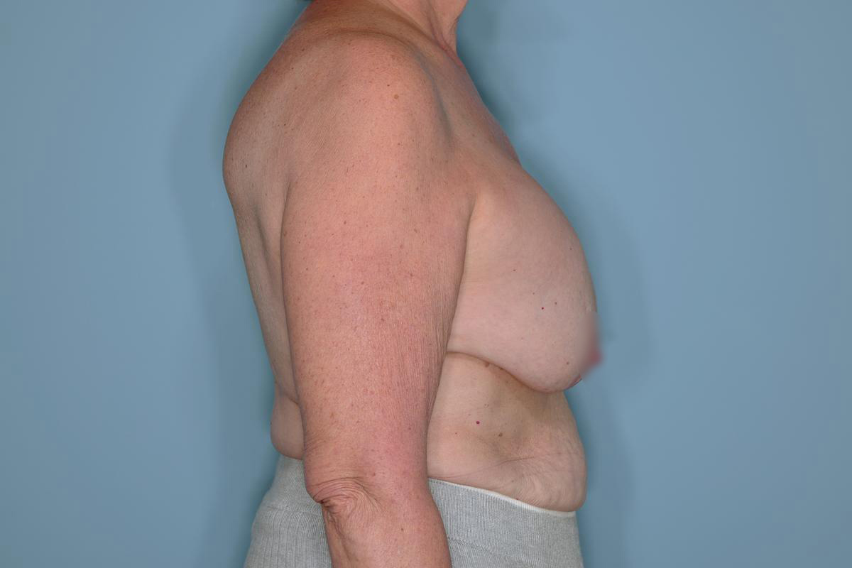 Implant Exchange Lift Before & After Patient #651